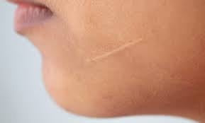 Scar tissue or birthmarks & hybrid tint/dye